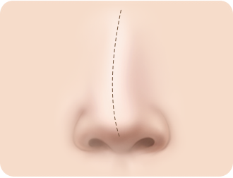 휘어진 정도가 가벼운 경우