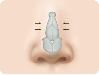 휘어진 정도가 심한 경우