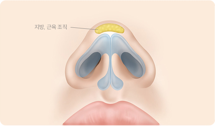 피부 아래 과다한 지방, 근육 조직을 적당량 제거하여 날렵한 코끝을 완성