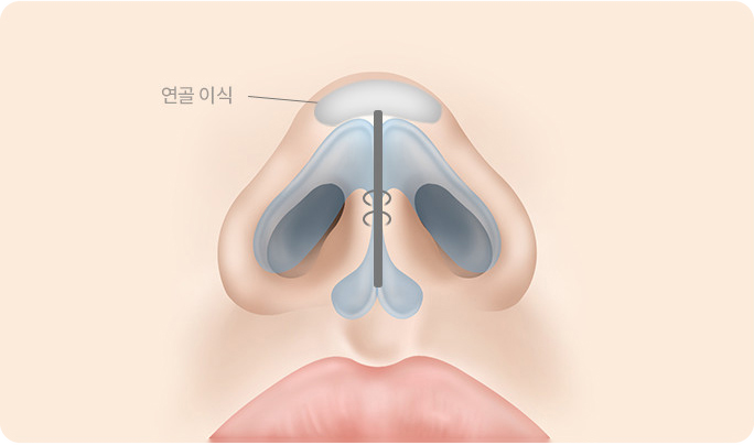 벌어진 연골을 묶어주고 자가연골로 지지대를 세움. 코끝에 연골 이식을 추가하면 더욱 오뚝해지는 코끝으로 업그레이드됨