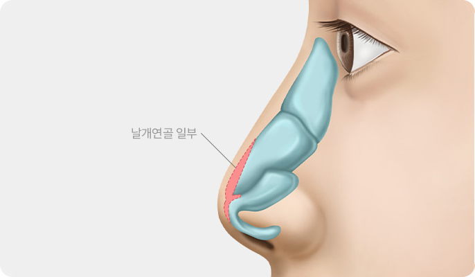 날개연골 일부를 절제