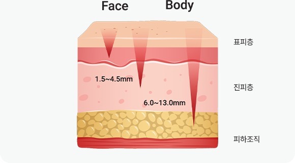[POINT 03] [HI Facial – 30만 샷 HIFU 맞춤 리프팅] 하이페이셜은 6종 카트리지를 활용한 고강도 집속 초음파(HIFU)